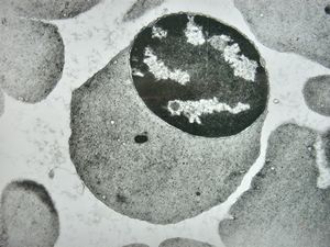 F,43y. | blood - hairy cell leukemia - normoblast